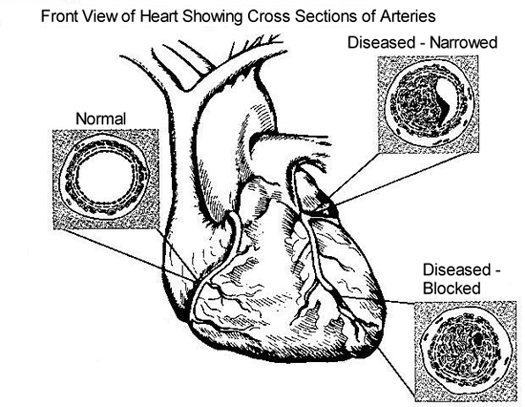 Coronary Artery Disease