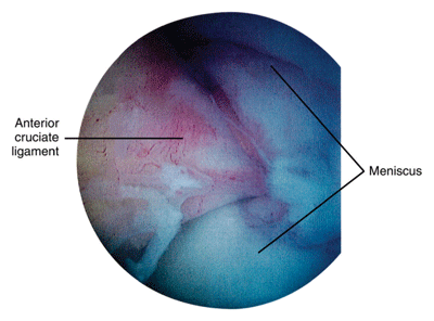 Knee arthroscopy Knee arthroscopy
