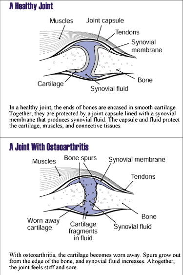 Osteoarthritis Joint Abnormalities Osteoarthritis Joint Abnormalities